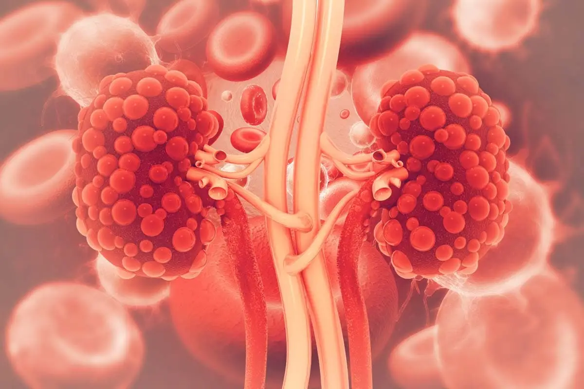 Polycystic kidney disease in cats