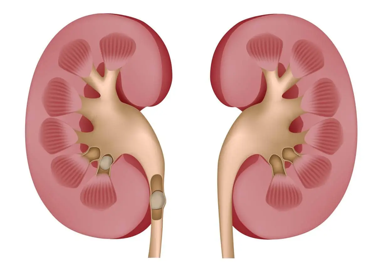 Kidney stones in cats