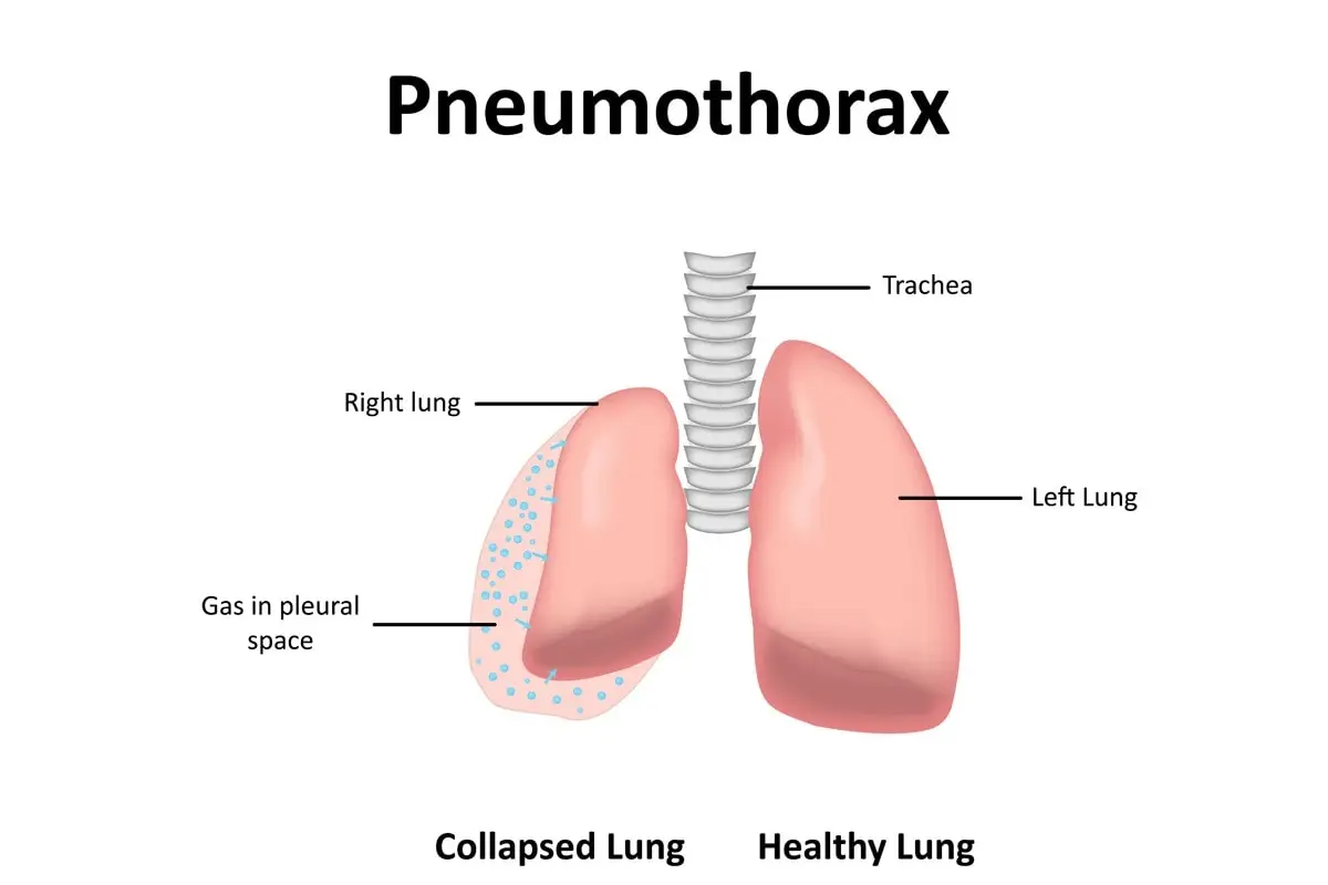 Pneumothorax in cats