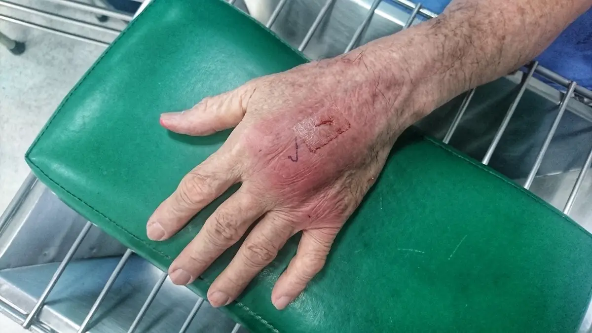 Cat bite wound with cellulitis