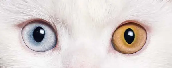 Complete heterochromia