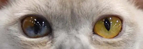 Sectoral heterochromia
