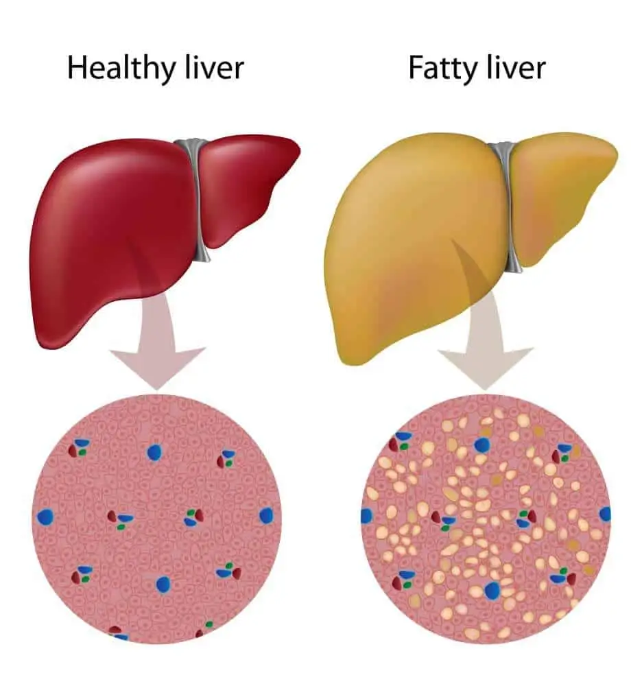 fatty liver disease in cats
