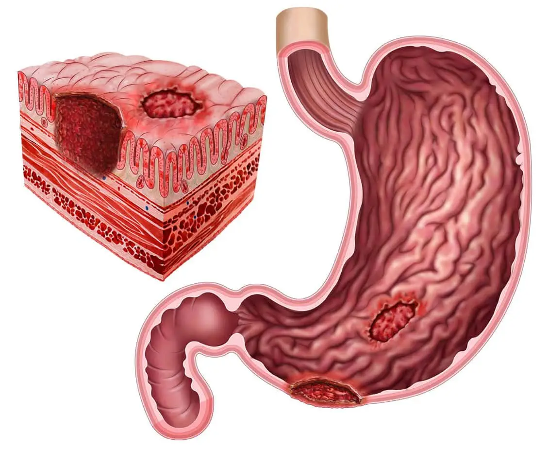 Stomach ulcer