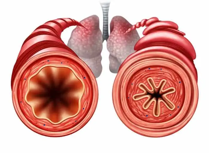 Asthma in cats