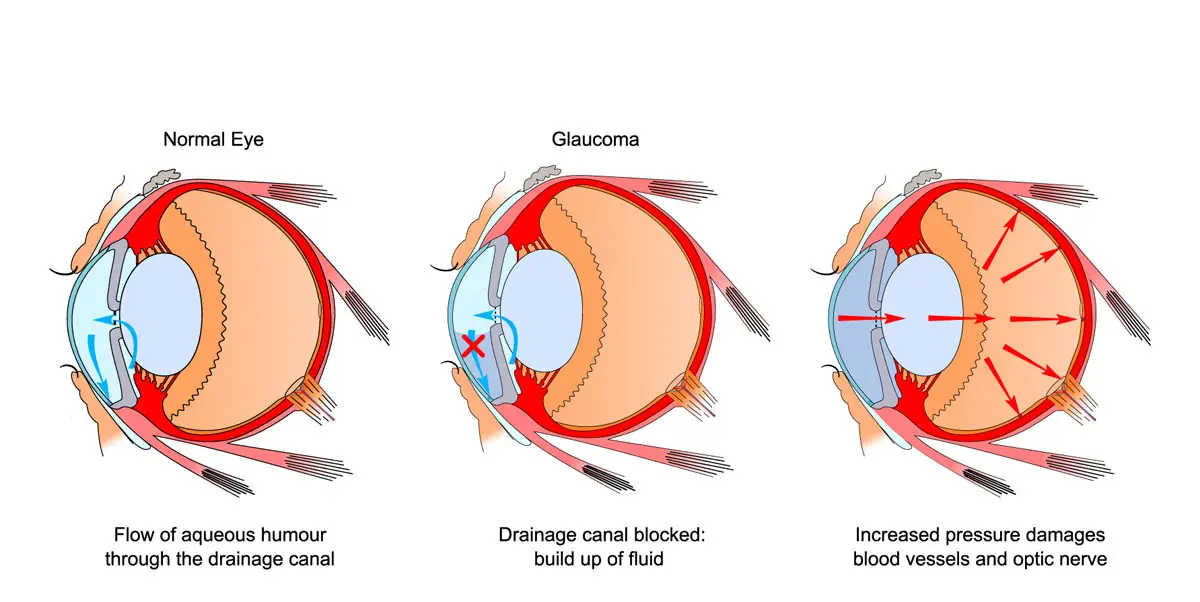 How glaucoma develops