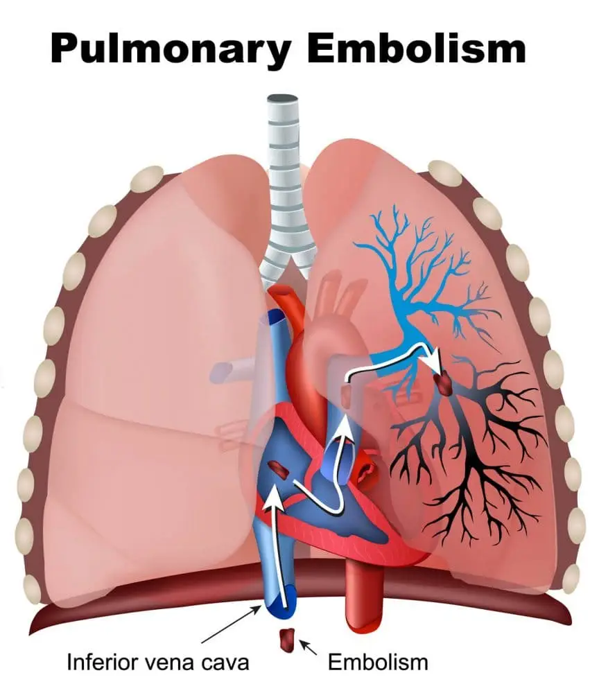 Tromboembolismo pulmonar en gatos