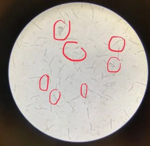 Struvite crystals