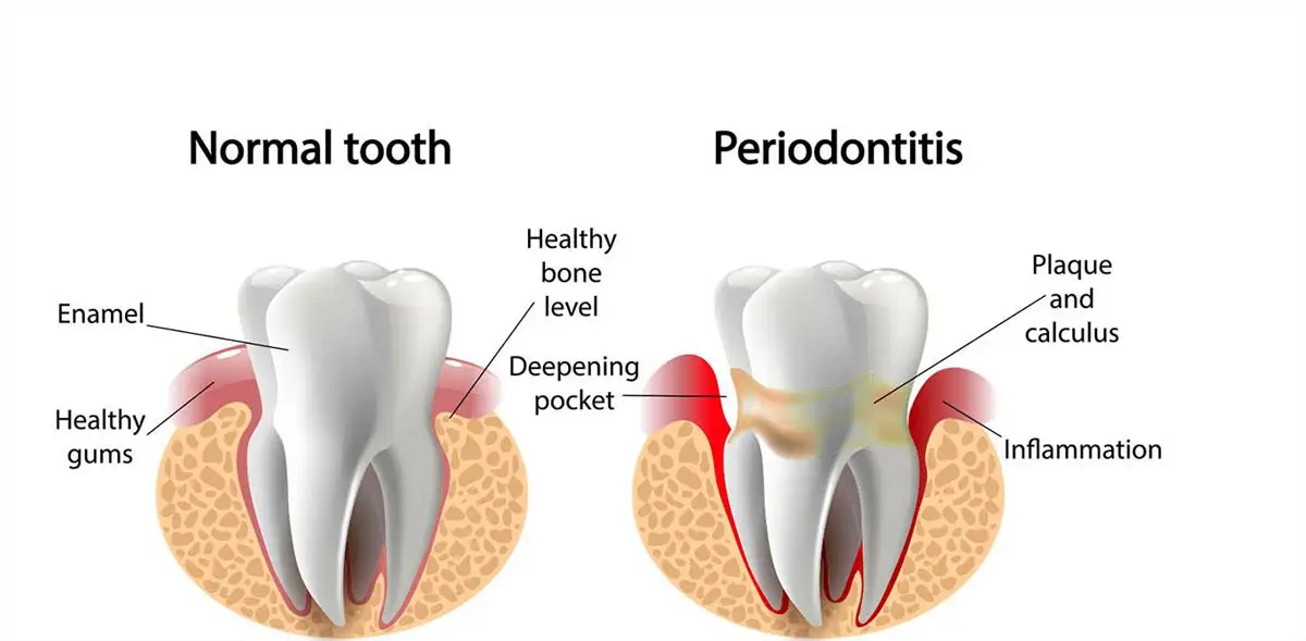 Normal gums compared to gum disease