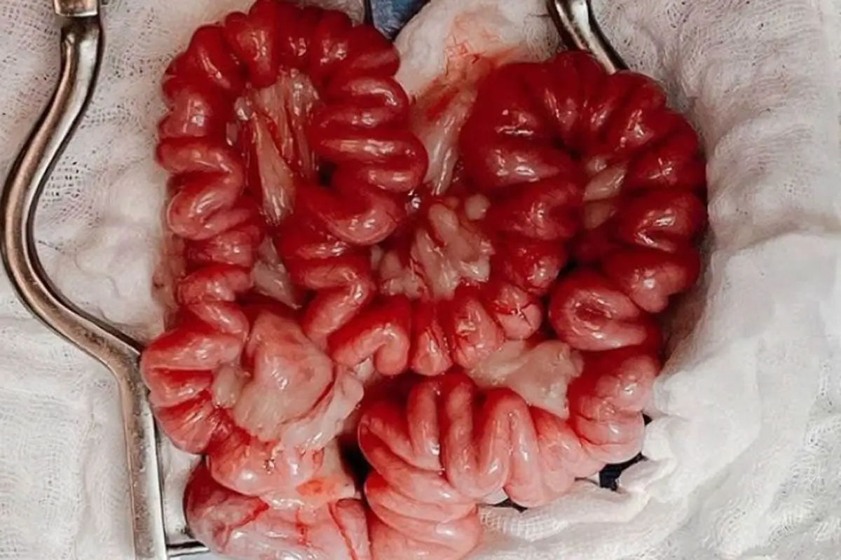 Plication of the intestines
