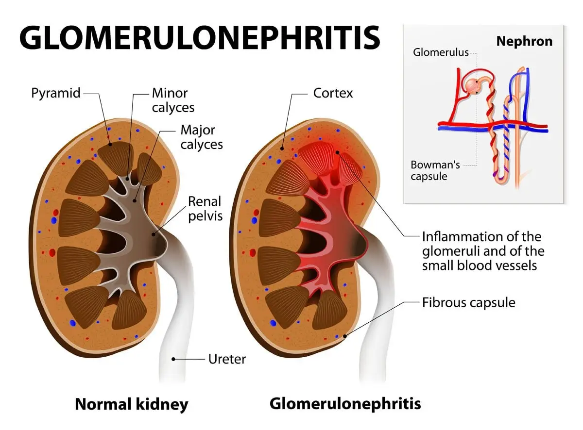 Glomerulonephritis in cats