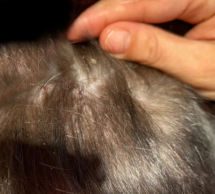 miliary dermatitis scabs