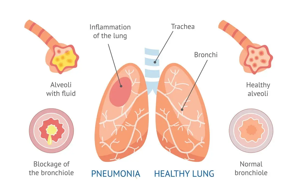 Pneumonia