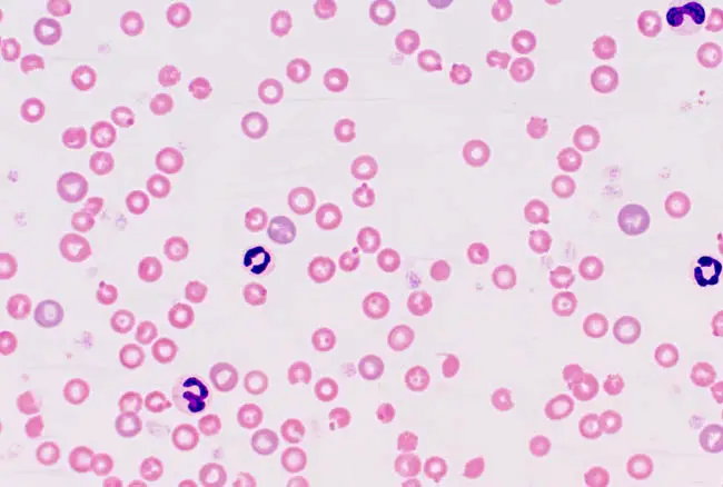 Heinz body hemolytic anemia