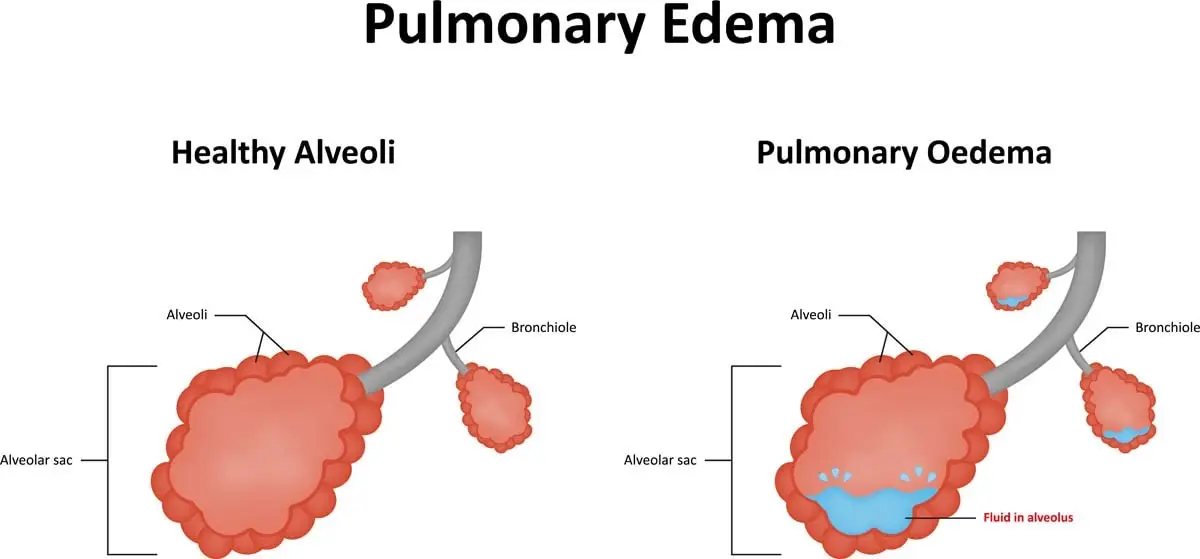 What is pulmonary edema?