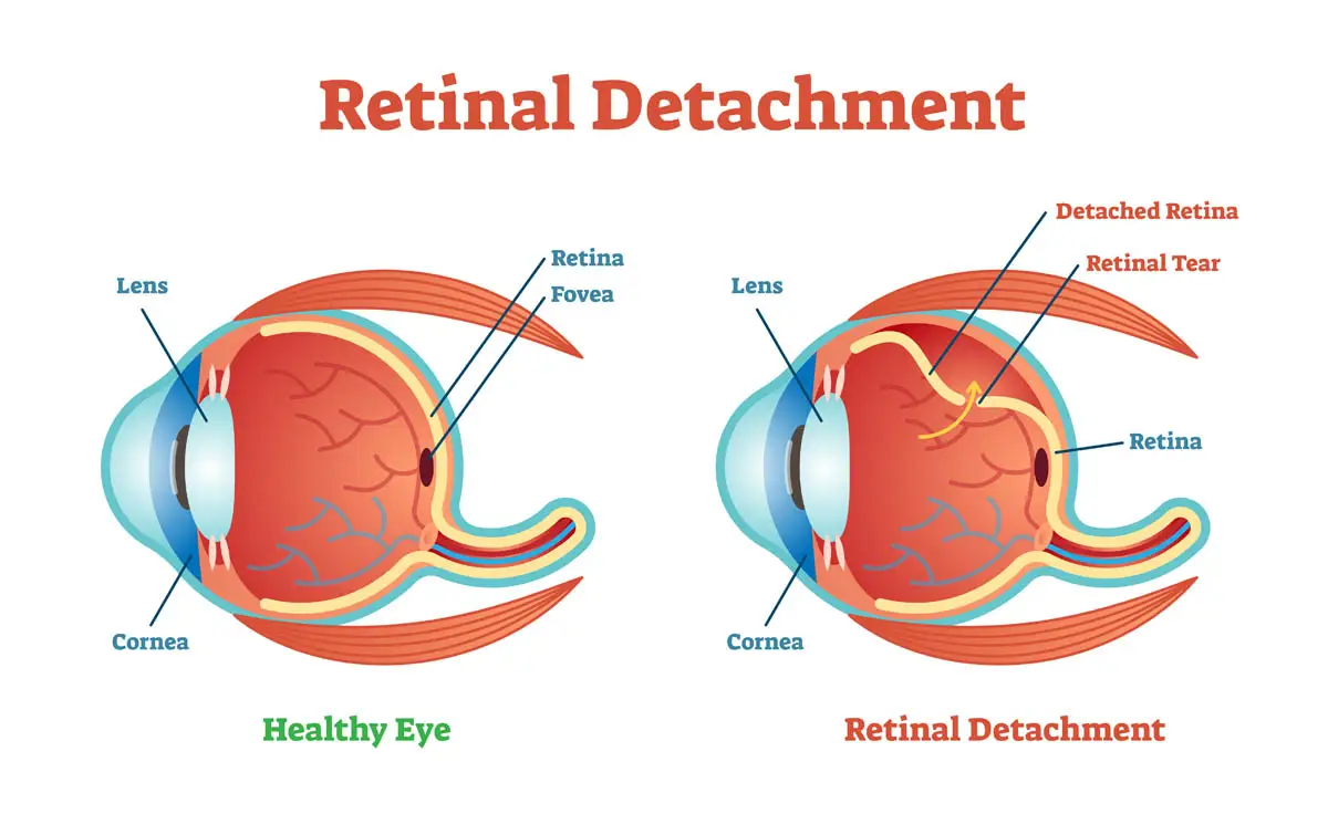 Retinal detachment in cats