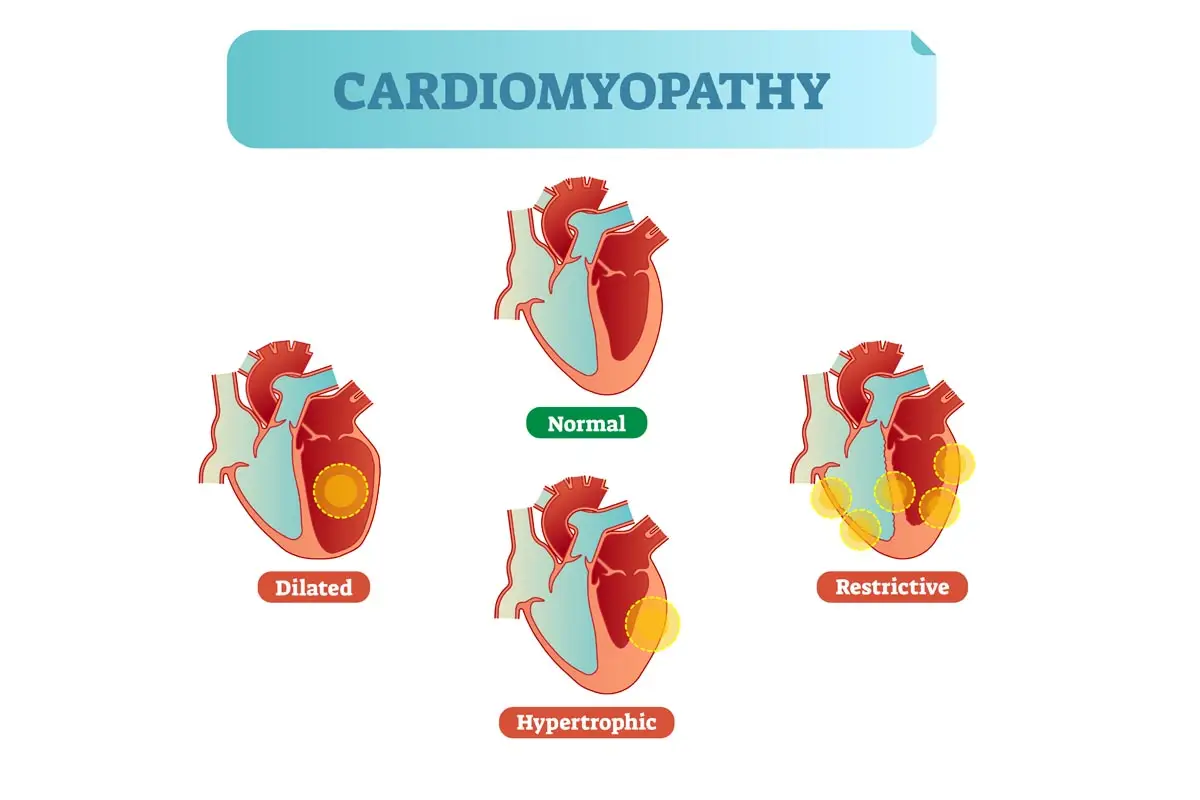 Cardiomyopathy