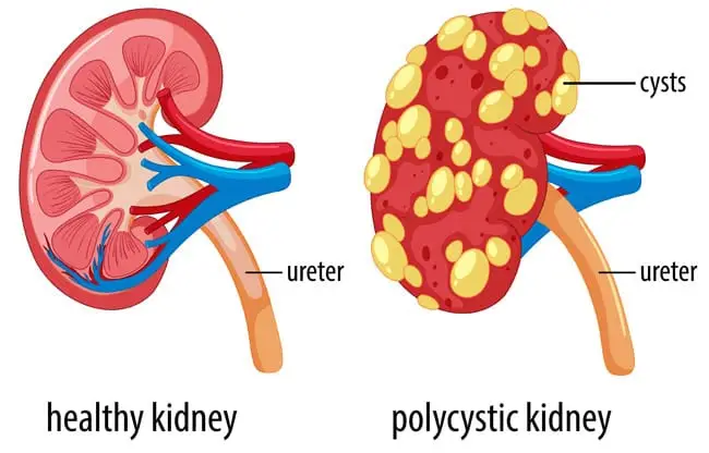 Polycystic kidney disease