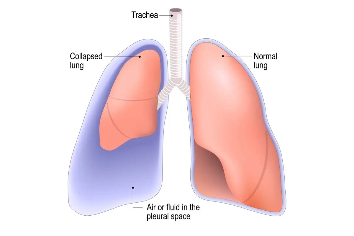 Pleural effusion