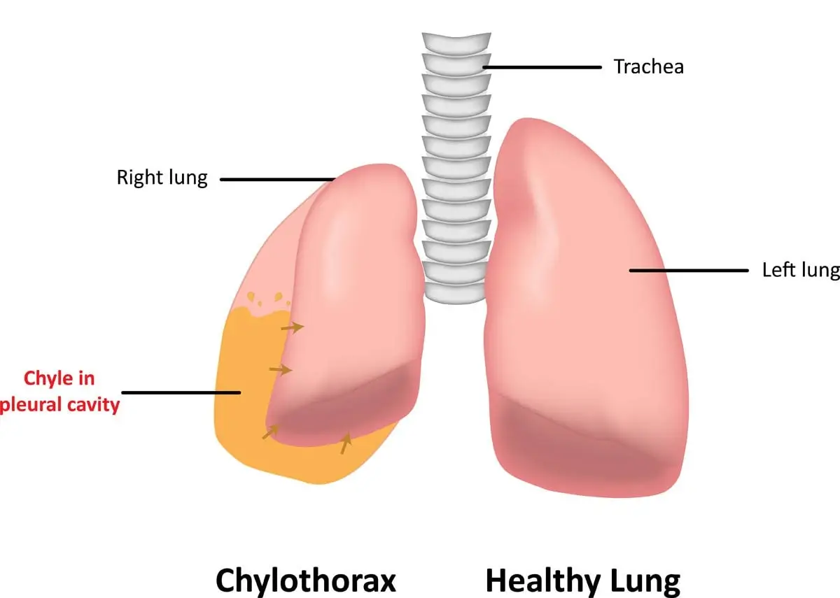 Chylothorax in cats