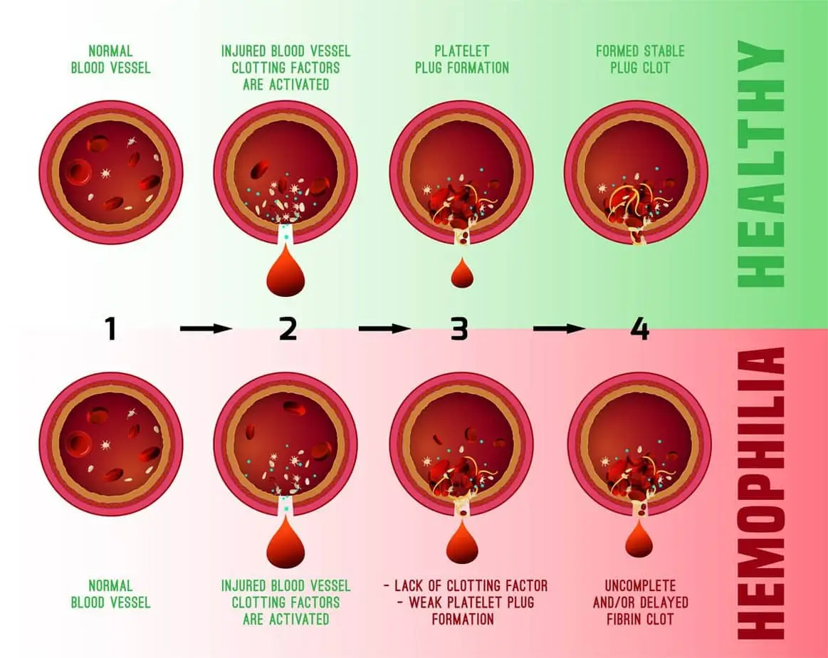 What is hemophilia?