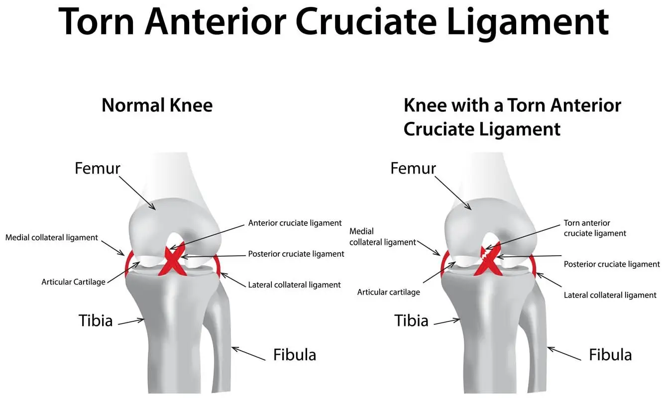 Cruciate ligament rupture in cats
