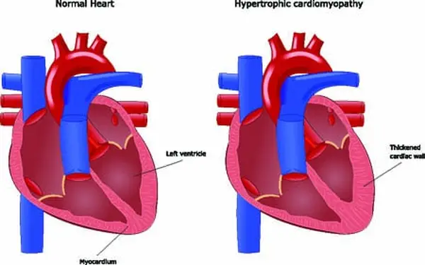 Feline hypertrophic cardiomyopathy