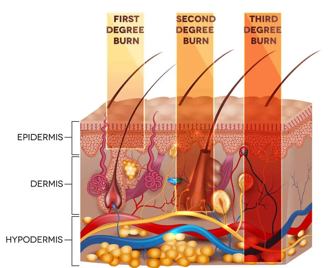 Degrees of burns