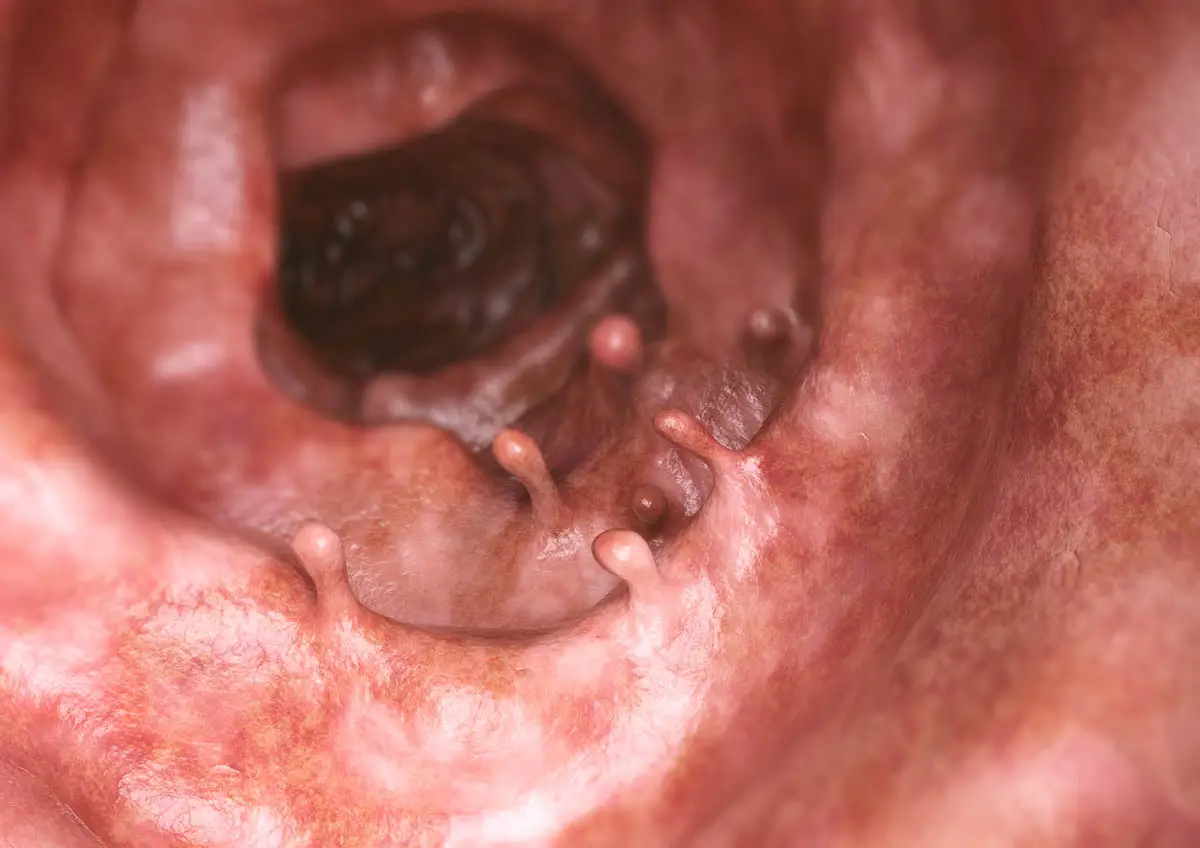 Rectoanal polyps