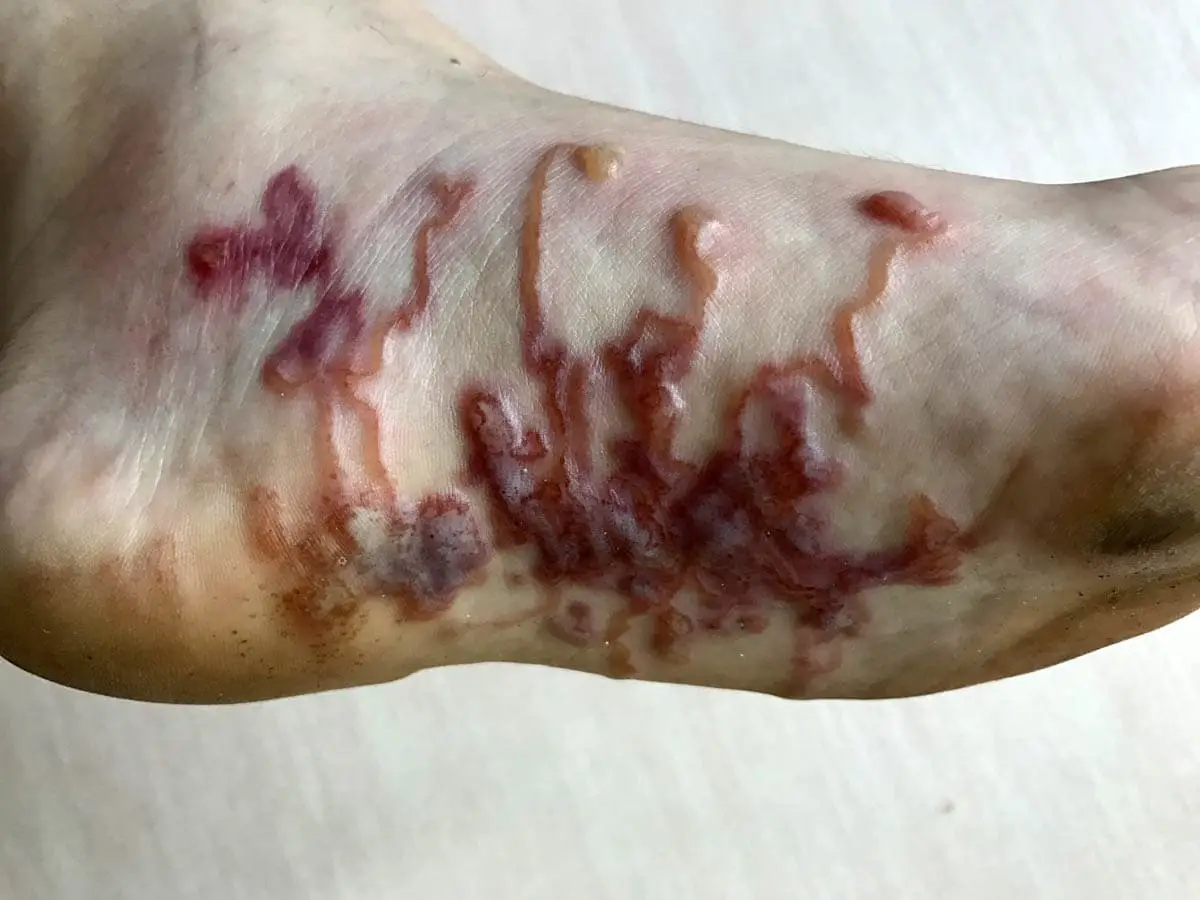 Cutaneous larva migrans