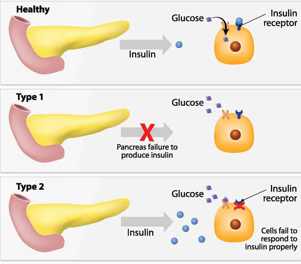 What is diabetes?