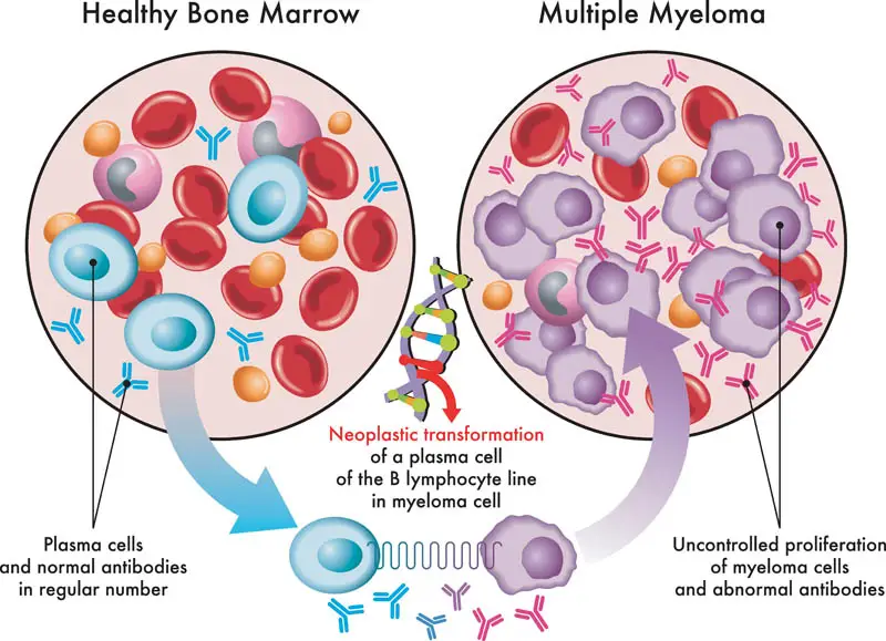 What is multiple myeloma in cats?