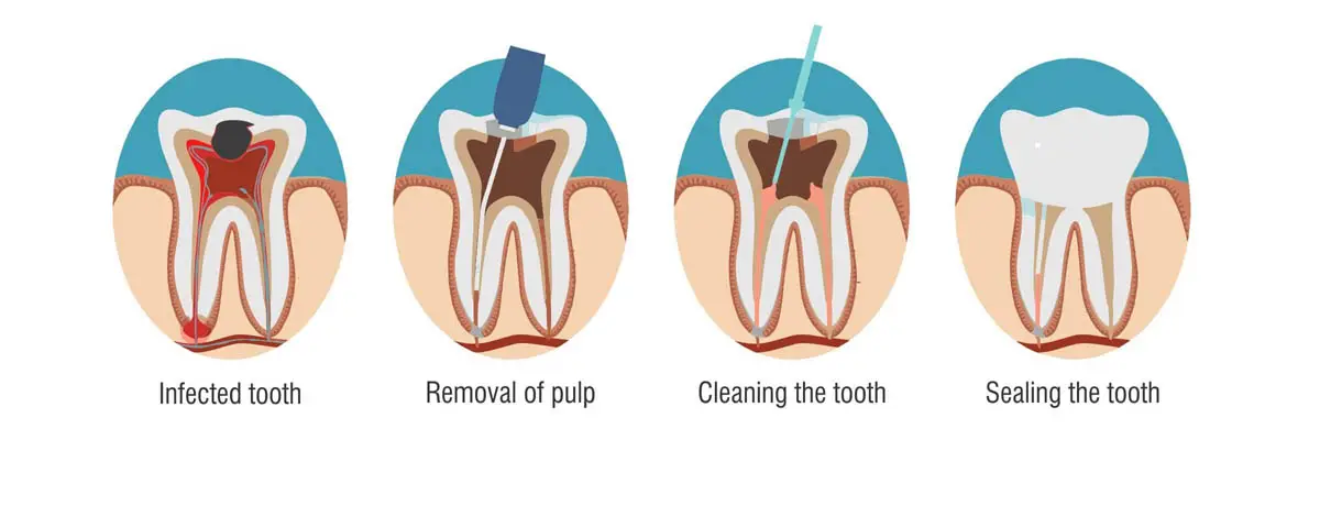 Root canal treatment for cats