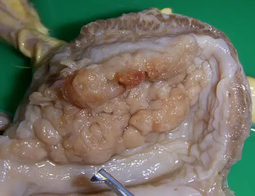 Transitional cell carcinoma
