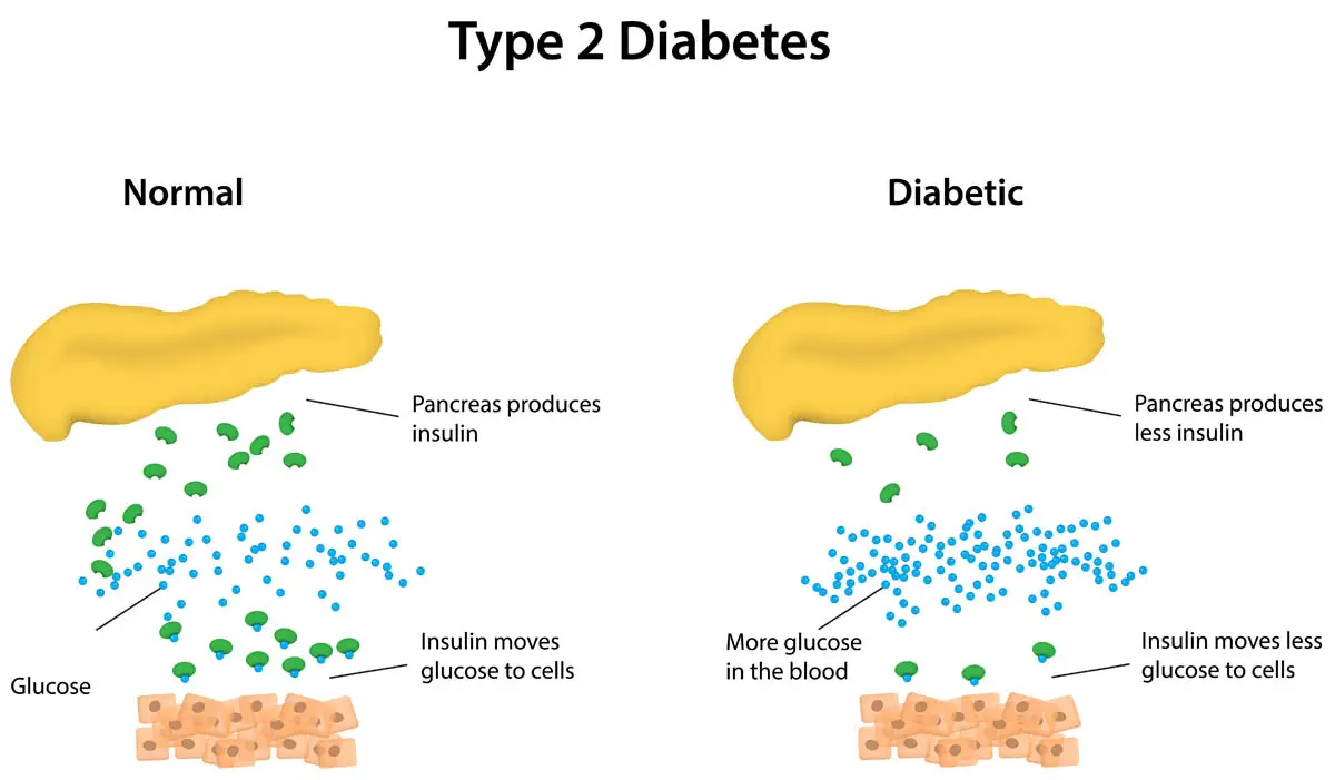 Type two diabetes