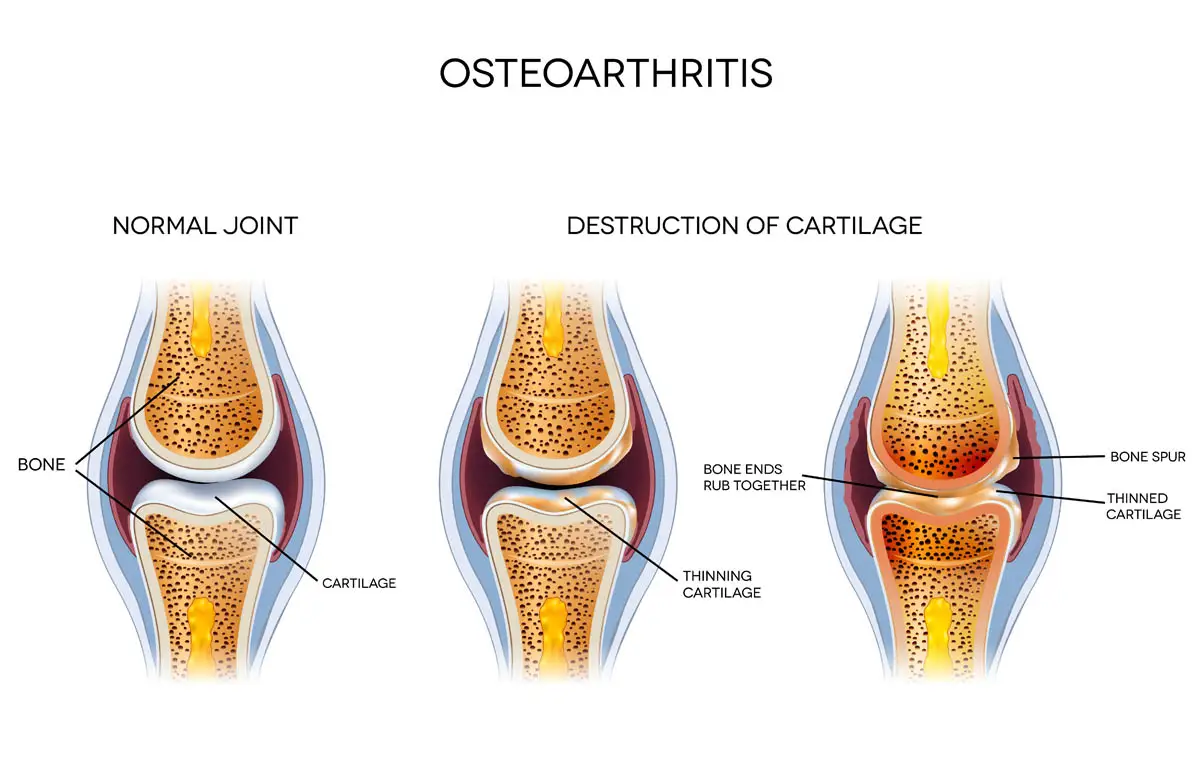 Osteoarthritis