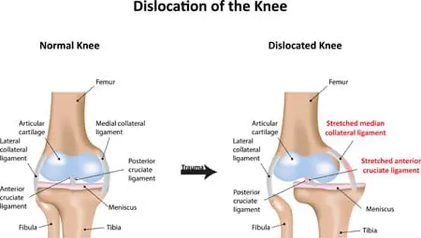 Joint dislocation