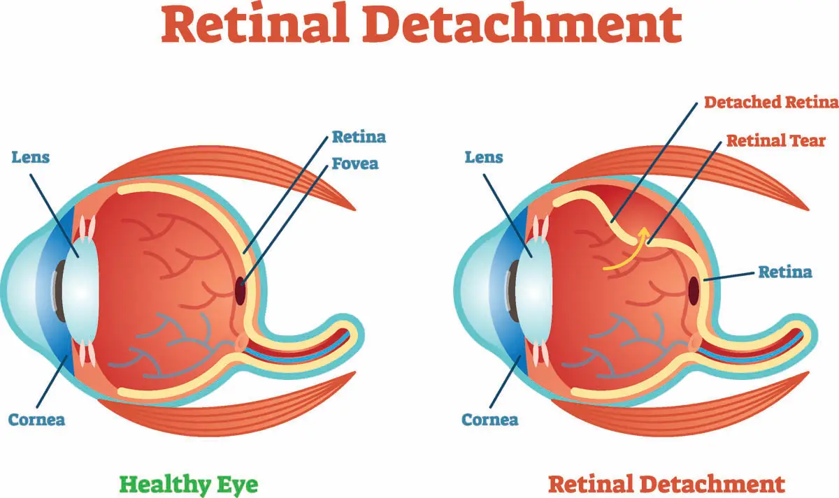 Retinal detachment in cats