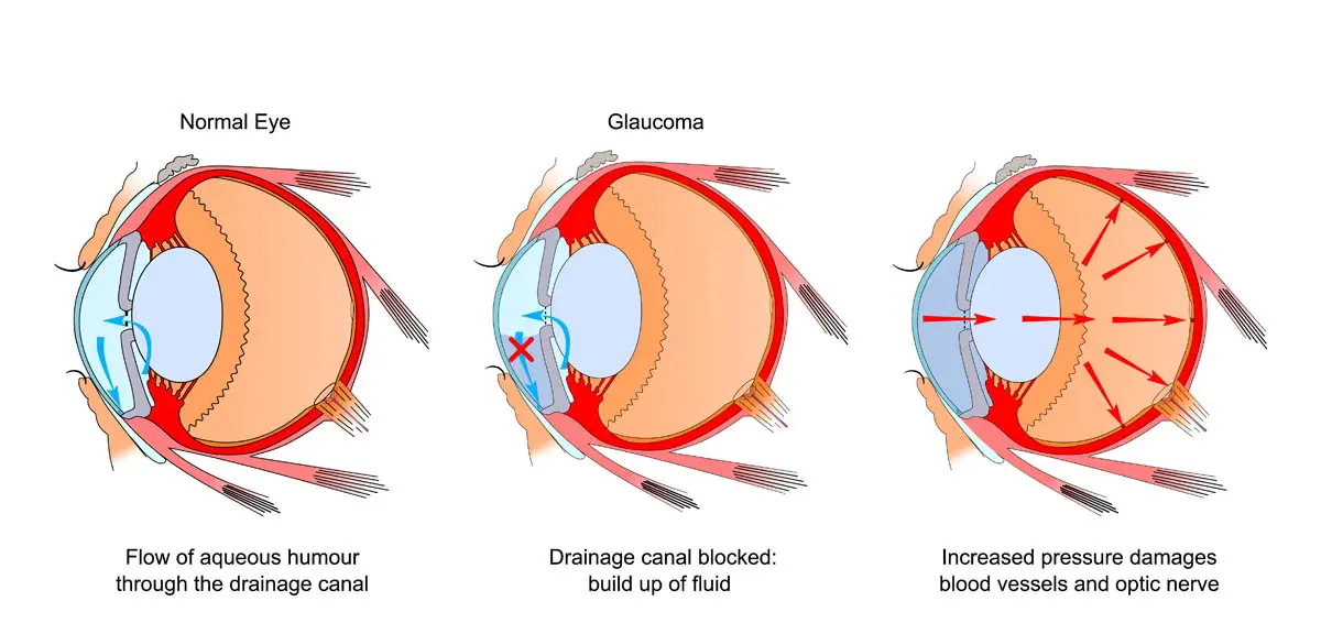 Glaucoma in cats