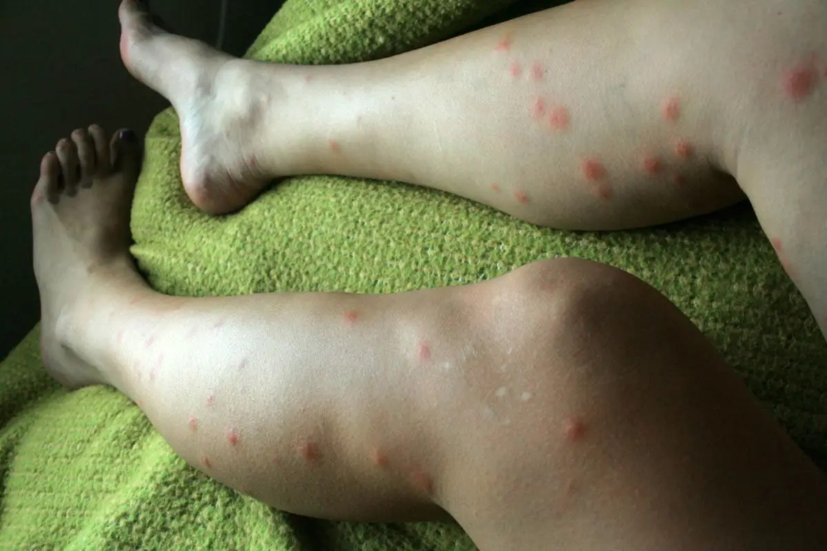 Chiggers bites on a woman