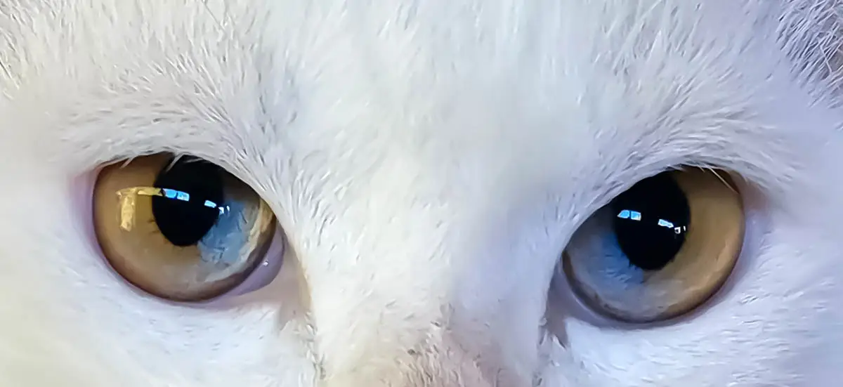 Sectoral heterochromia