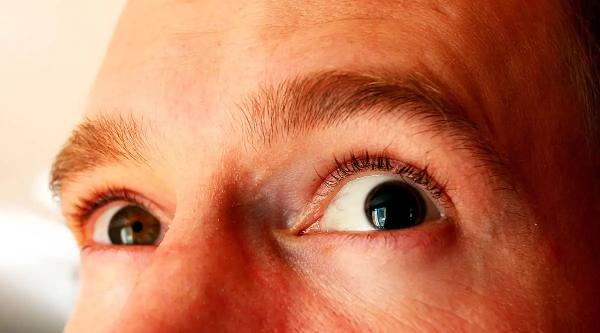 Anisocoria